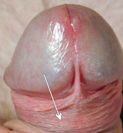Ridged band of an uncircumcised penis