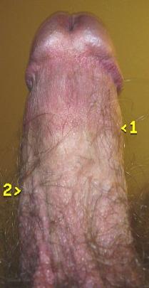 Hairy Shaft, caused by circumcision