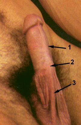 Circumcision causing scrotal skin to be drawn up the penis shaft